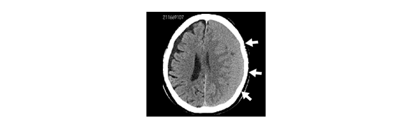 慢性硬膜下血腫のCT画像