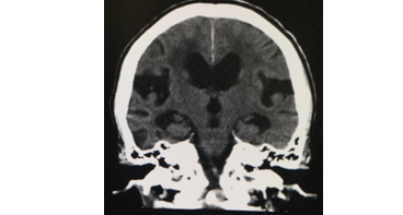 特発性正常圧水頭症CT