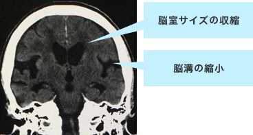 特発性正常圧水頭症CT