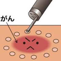 ESD(粘膜下層剥離術)の具体的な方法１