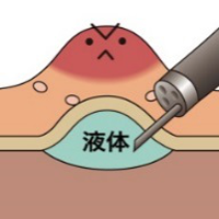 ESD(粘膜下層剥離術)の具体的な方法2