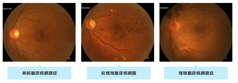 糖尿病性網膜症患者さんの蛍光眼底造影検査の写真