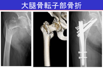 大腿骨近位部骨折