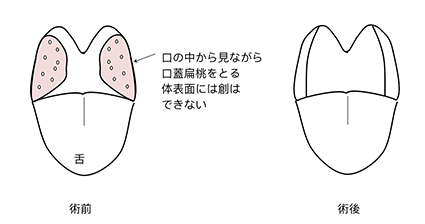 口蓋扁桃摘出のシェーマ