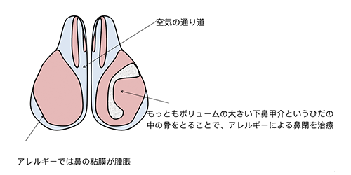 粘膜下下甲介骨切除のシェーマ