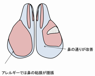 粘膜下下甲介骨切除のシェーマ