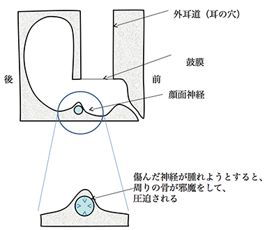 顔面神経減荷術のシェーマ