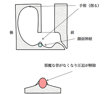 顔面神経減荷術のシェーマ