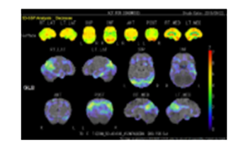 アルツハイマー型認知症のR1スペクト