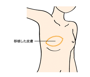 広背筋再建の図2