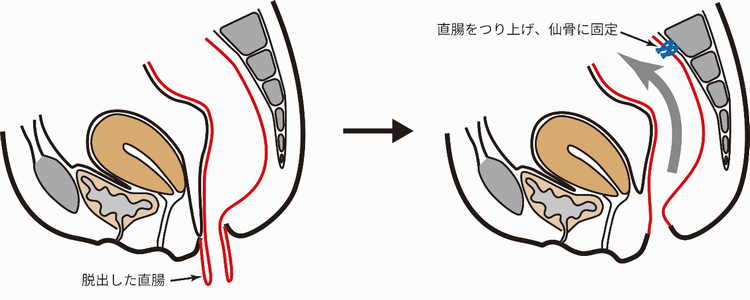 直腸脱に対する腹腔鏡下直腸固定術の図