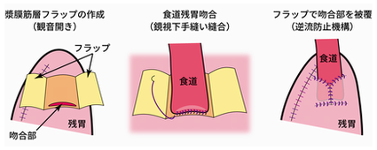 上部胃癌に対する腹腔鏡下噴門側胃切除の図