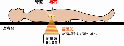 体外衝撃波結石破砕術の様子