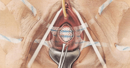 前腟壁と膀胱との間にメッシュが挿入された様子